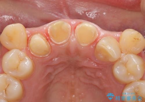 オールセラミッククラウン 長期間放置してきた前歯の虫歯治療の治療中