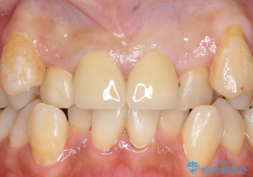 オールセラミッククラウン 長期間放置してきた前歯の虫歯治療の治療後