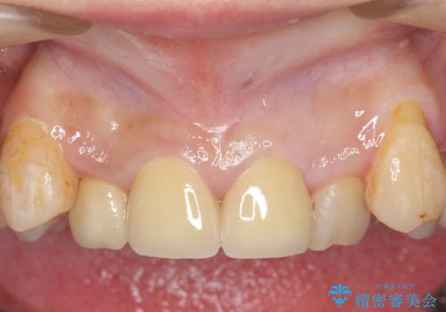オールセラミッククラウン　長期間放置してきた前歯の虫歯治療の症例 治療後