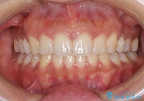 抜歯矯正の後戻り インビザラインによる再矯正治療