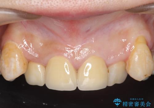 オールセラミッククラウン 長期間放置してきた前歯の虫歯治療の治療後
