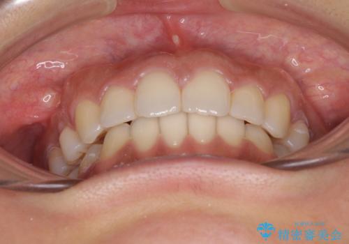 抜歯矯正の後戻り インビザラインによる再矯正治療の治療後