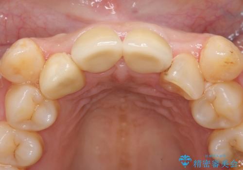 オールセラミッククラウン 長期間放置してきた前歯の虫歯治療の治療後