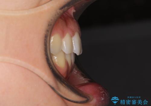 抜歯矯正の後戻り インビザラインによる再矯正治療の治療後