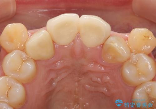 オールセラミッククラウン 長期間放置してきた前歯の虫歯治療の治療後