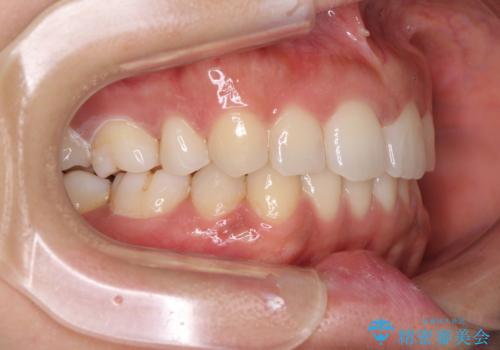 抜歯矯正の後戻り インビザラインによる再矯正治療の治療後