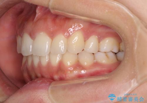 抜歯矯正の後戻り インビザラインによる再矯正治療の治療後