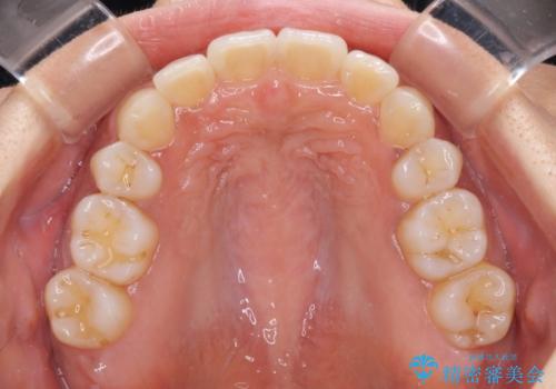 抜歯矯正の後戻り インビザラインによる再矯正治療の治療後