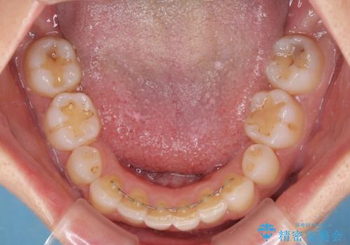抜歯矯正の後戻り インビザラインによる再矯正治療の治療後