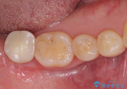 抜歯されたままの奥歯　ストローマンインプラントによる欠損補綴治療の症例 治療後