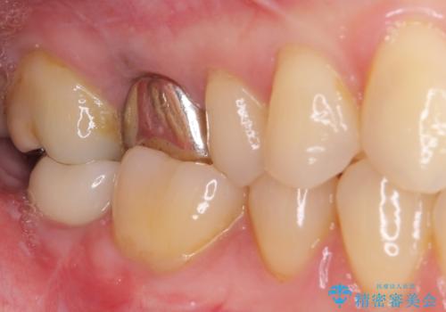 抜歯されたままの奥歯 ストローマンインプラントによる欠損補綴治療の治療後