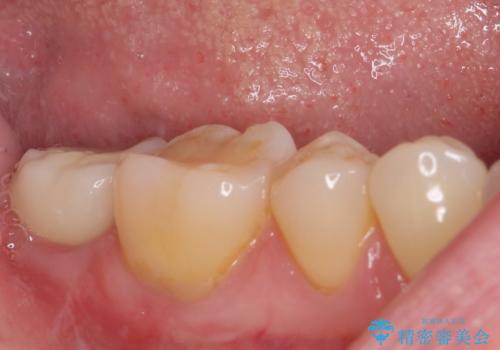 抜歯されたままの奥歯 ストローマンインプラントによる欠損補綴治療の治療後