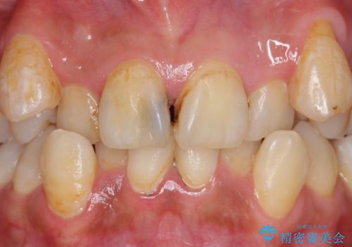 オールセラミッククラウン　長期間放置してきた前歯の虫歯治療の治療前