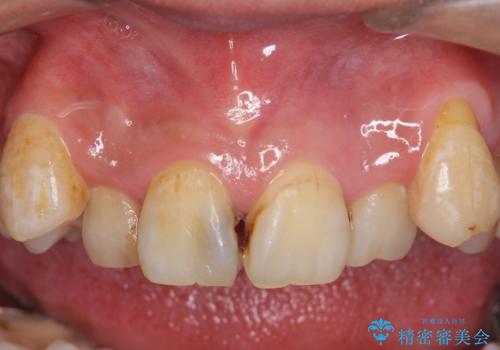 オールセラミッククラウン　長期間放置してきた前歯の虫歯治療の症例 治療前
