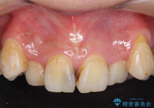 オールセラミッククラウン　長期間放置してきた前歯の虫歯治療の治療前