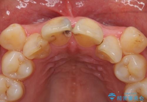 オールセラミッククラウン 長期間放置してきた前歯の虫歯治療の治療前