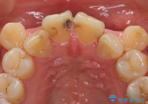 オールセラミッククラウン 長期間放置してきた前歯の虫歯治療の治療前