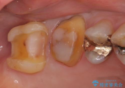 オールセラミッククラウン・セラミックインレー 歯茎より深い虫歯の治療の治療中