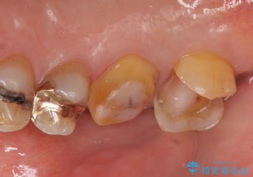 オールセラミッククラウン・セラミックインレー 歯茎より深い虫歯の治療の治療中