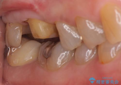 オールセラミッククラウン・セラミックインレー 歯茎より深い虫歯の治療の治療中