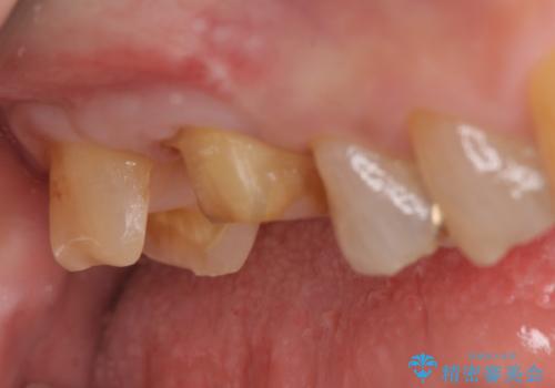 オールセラミッククラウン・セラミックインレー　歯茎より深い虫歯の治療の治療中