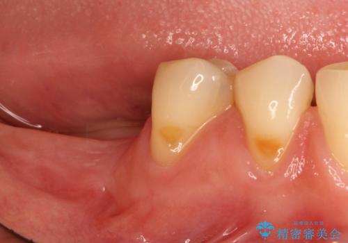 奥歯が痛い。抜歯~奥歯のインプラント の治療中
