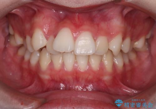 笑顔がきれいになった。抜歯矯正(審美装置)の症例 治療前