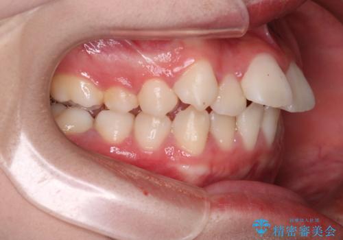 笑顔がきれいになった。抜歯矯正(審美装置)の治療前