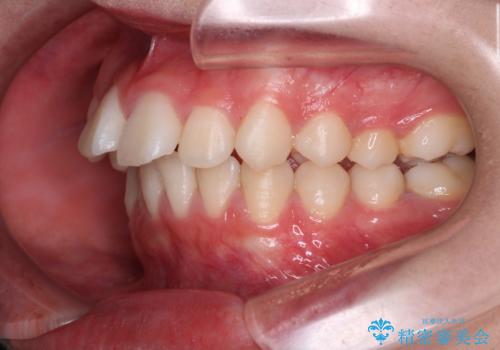 笑顔がきれいになった。抜歯矯正(審美装置)の治療前