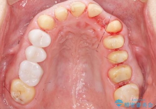 歯並びをきれいにしたい、歯を真っ白にしたい 40代男性の治療中