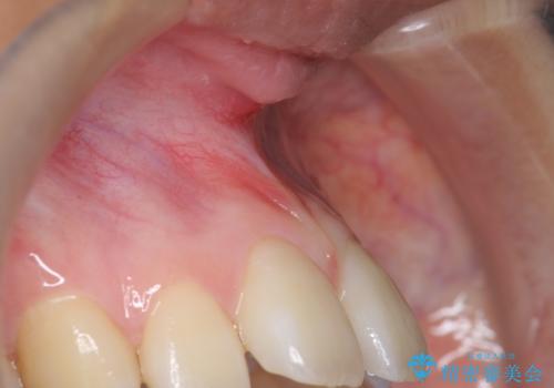 上唇小帯切除 矯正前の予防的処置の治療後