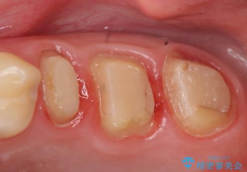 オールセラミッククラウン 痛みでものが咬めない歯の治療の治療中