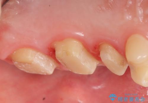 オールセラミッククラウン 痛みでものが咬めない歯の治療の治療中