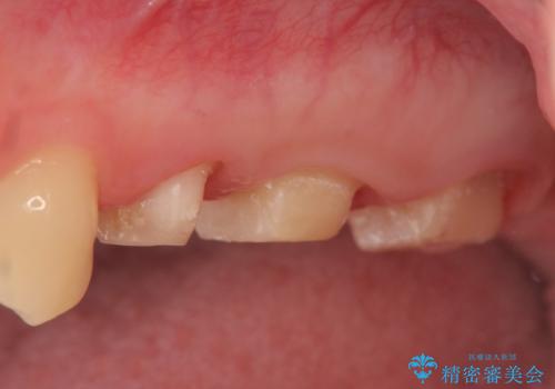 オールセラミッククラウン 痛みでものが咬めない歯の治療の治療中