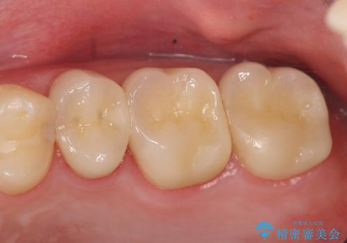 オールセラミッククラウン 痛みでものが咬めない歯の治療の治療後