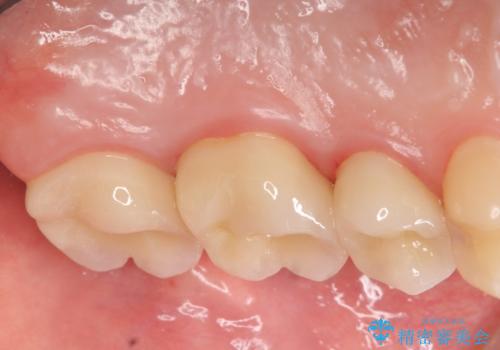 オールセラミッククラウン 痛みでものが咬めない歯の治療の治療後