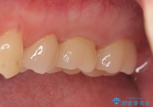 オールセラミッククラウン 痛みでものが咬めない歯の治療の治療後