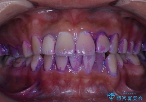 10年ぶりの歯科医院への来院の症例 治療前