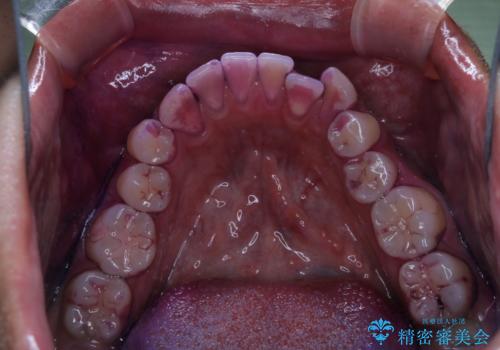 10年ぶりの歯科医院への来院の治療前