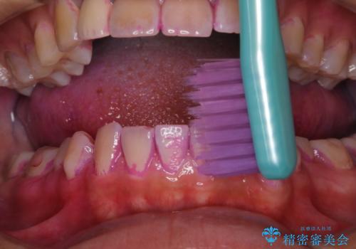 10年ぶりの歯科医院への来院の治療中