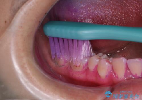 10年ぶりの歯科医院への来院の治療中