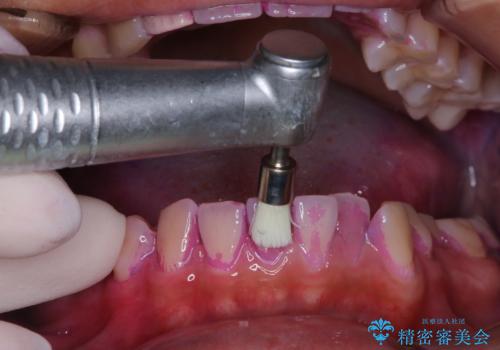10年ぶりの歯科医院への来院の治療中