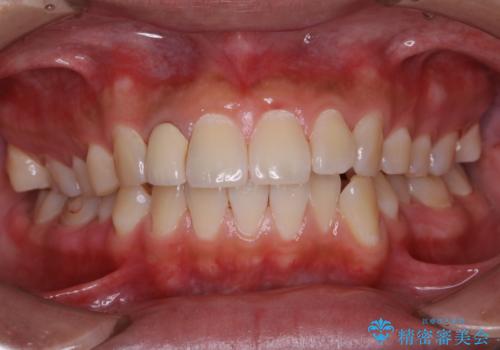 10年ぶりの歯科医院への来院の症例 治療後