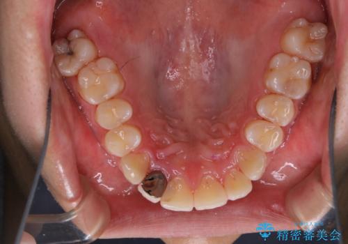 10年ぶりの歯科医院への来院の治療後