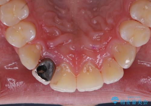 10年ぶりの歯科医院への来院の治療後