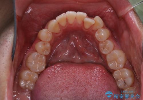 10年ぶりの歯科医院への来院の治療後