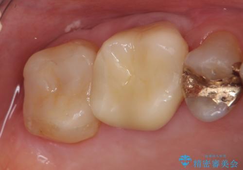 オールセラミッククラウン・セラミックインレー　歯茎より深い虫歯の治療の症例 治療後