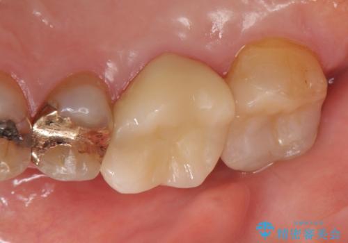 オールセラミッククラウン・セラミックインレー 歯茎より深い虫歯の治療の治療後