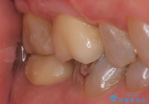 オールセラミッククラウン・セラミックインレー 歯茎より深い虫歯の治療の治療後