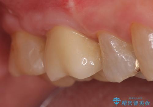 オールセラミッククラウン・セラミックインレー 歯茎より深い虫歯の治療の治療後